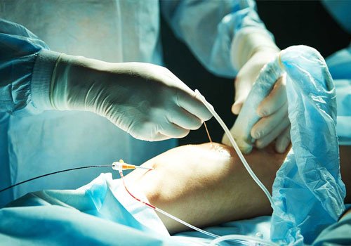 Vascular surgery